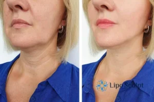 Double chin before and after Hi-Fu treatment 4 Book your double chin treatment Bracknell today! We are here to help!