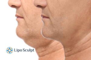 Double chin before and after Hi-Fu treatment 2 Double chin treatment Bracknell from Lipo Sculpt - feel more confident today!