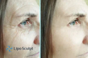 How to Fight Aging Symptoms 2 Do you want to Fight Aging Symptoms Bracknell? Contact Lipo Sculpt today!