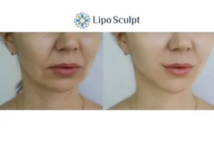 Explaining Total Skin Tightening Treatment And What It Can Do For You 2 Do you want to boost your self confidence? Give Morpheus8 Bracknell a try today!