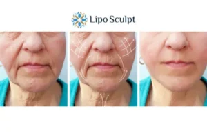 Explaining Total Skin Tightening Treatment And What It Can Do For You 3 Boost your confidence with Morpheus8 Bracknell call our team today!