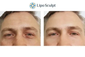 Explaining Total Skin Tightening Treatment And What It Can Do For You 6 Morpheus8 Bracknell book in today to find out more!