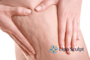 CoolSculpting for Legs: The Innovative Approach to Redefining Your Legs 5 Start your journey today book your coolsculpting treatment Bracknell online today!