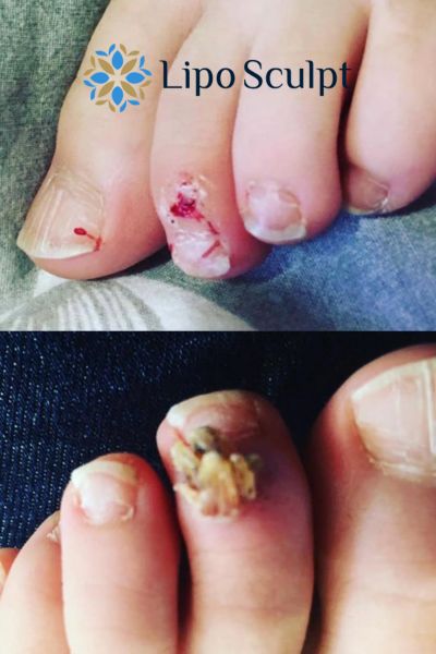 Wart removal customer results from Lipo Sculpt Bracknell