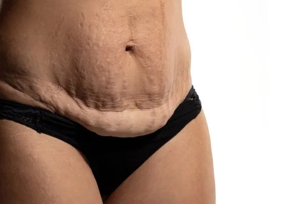 Lost the Weight but Not the Loose Skin? 1 image of womans stomach after weight loss showing loose skin Bracknell